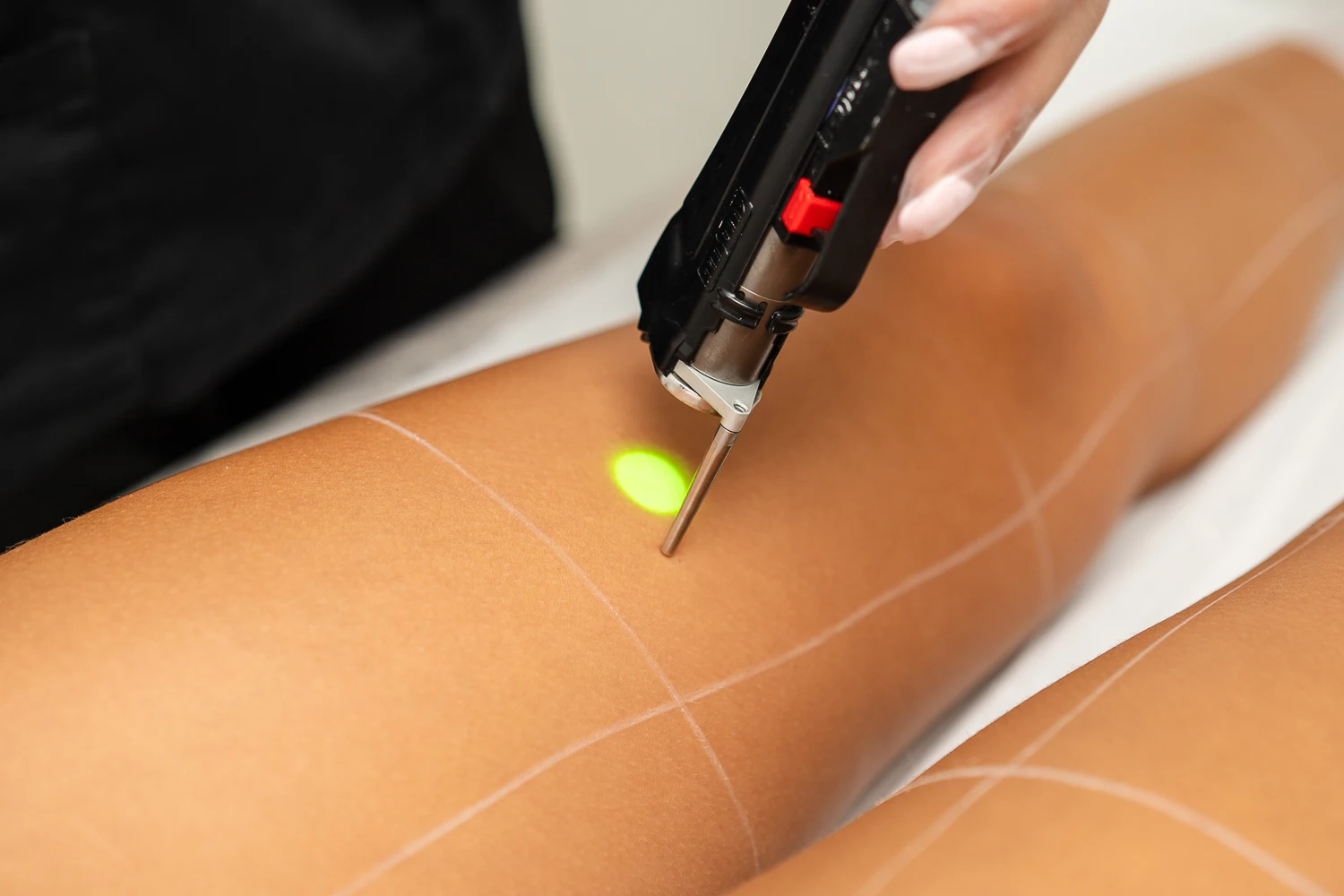 Laser Hair Removal Machine