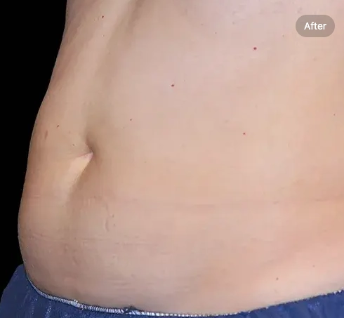 Coolsculpting after treatment