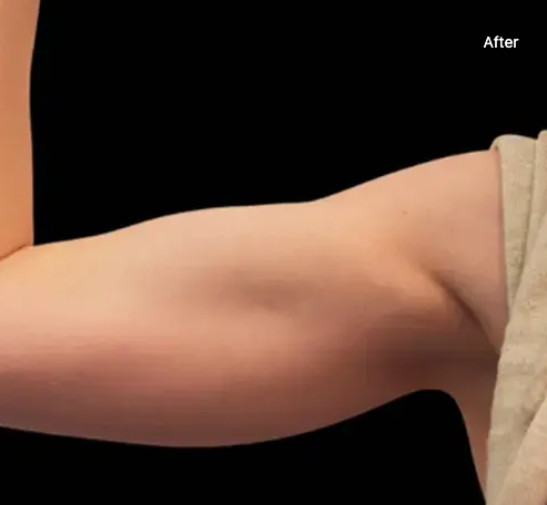 emsculpt after treatment