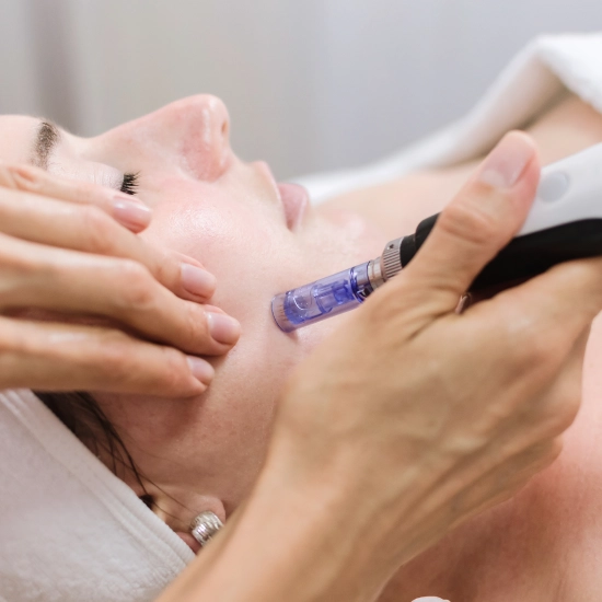 Microneedling treatment