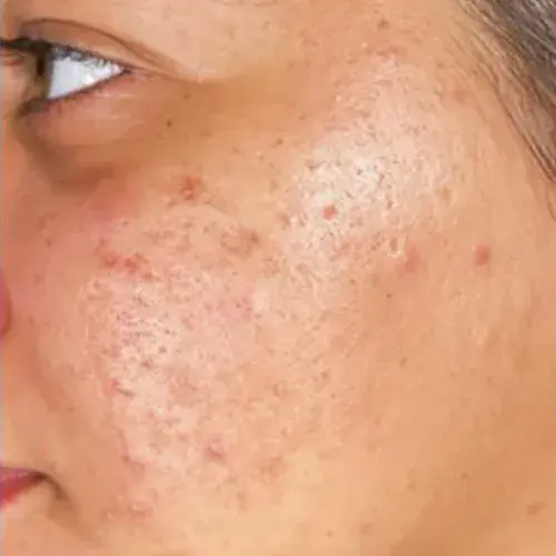hydrafacial-acne-after