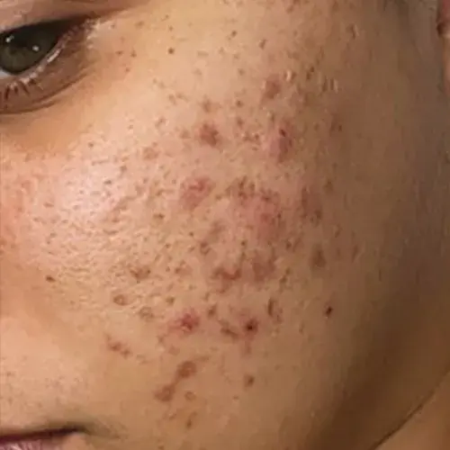 hydrafacial-acne-before